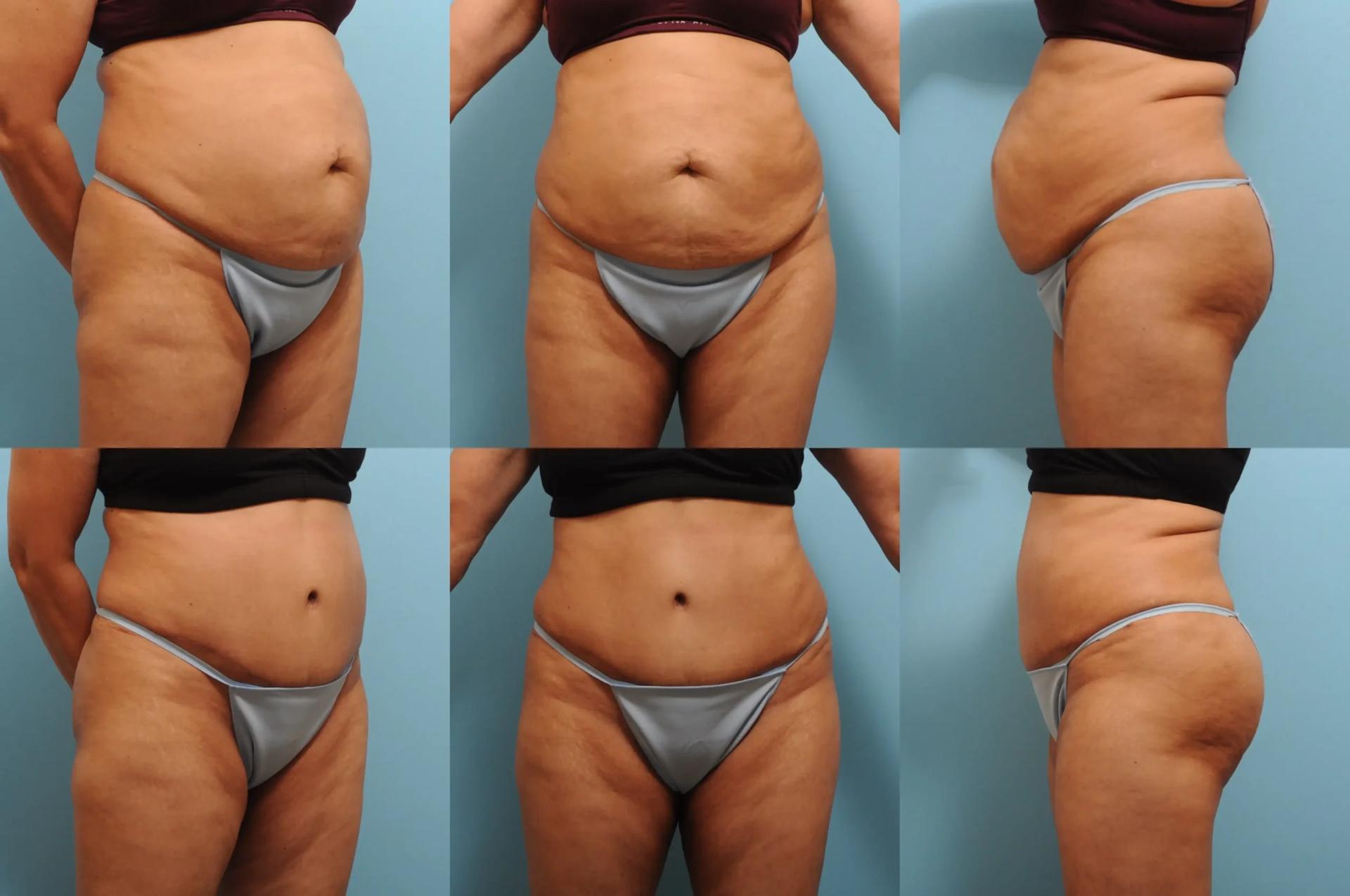The Plastic Surgery Group tummy tuck result — Montclair, NJ