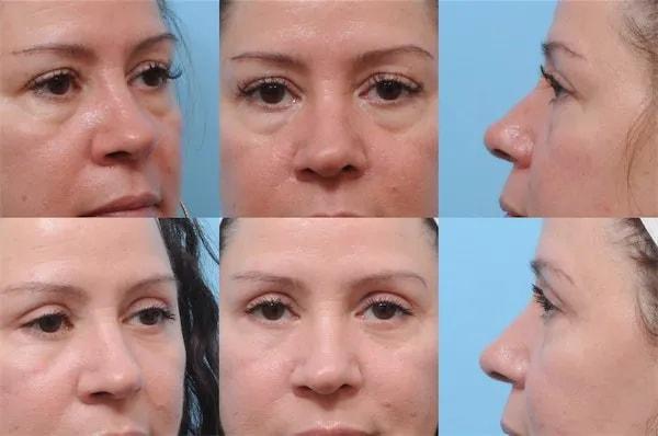 The Plastic Surgery Group eyelid lift result — Montclair, NJ