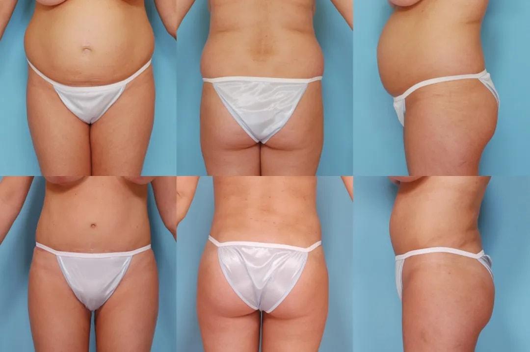 The Plastic Surgery Group tummy tuck result — Montclair, NJ