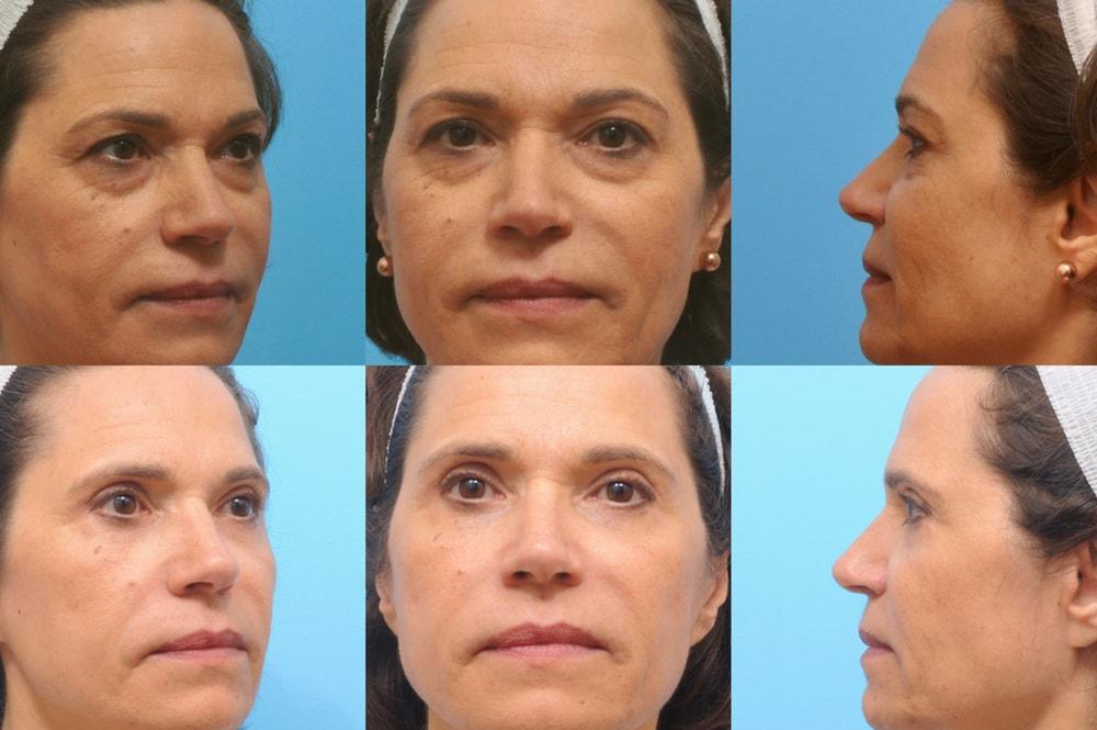 The Plastic Surgery Group eyelid lift result — Montclair, NJ