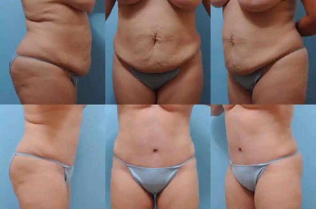 The Plastic Surgery Group tummy tuck result — Montclair, NJ