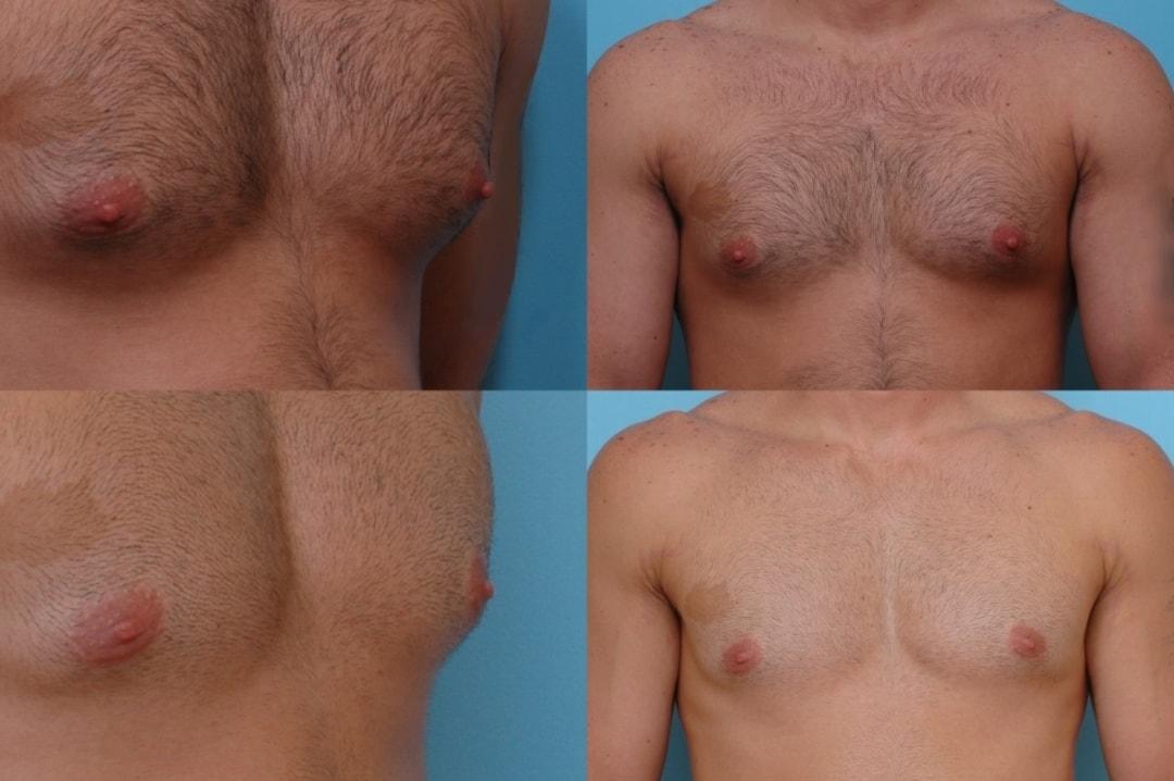 The Plastic Surgery Group gynecomastia result — Montclair, NJ