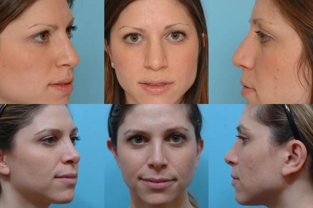 The Plastic Surgery Group rhinoplasty result — Montclair, NJ