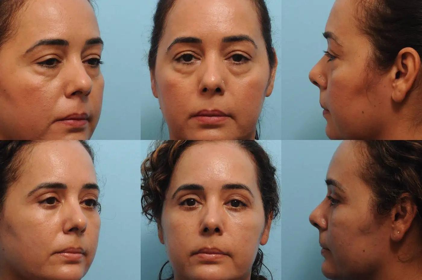 The Plastic Surgery Group eyelid lift result — Montclair, NJ