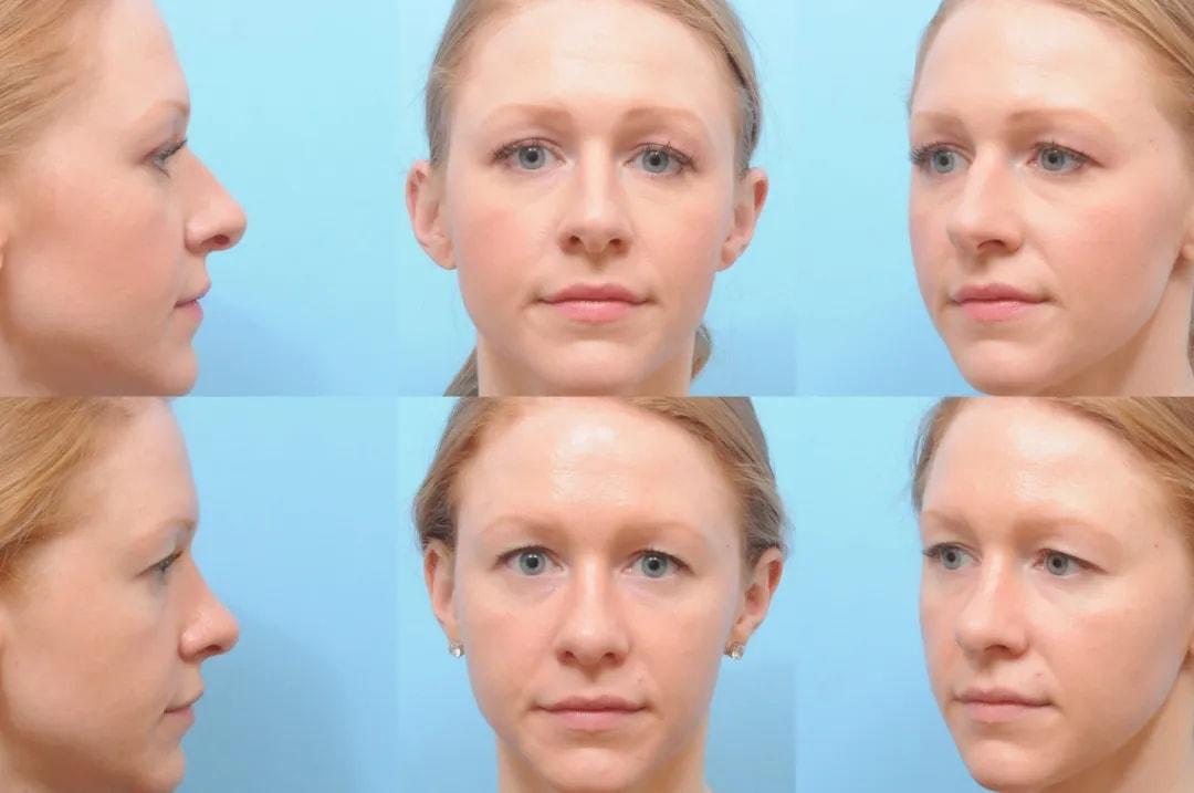 The Plastic Surgery Group rhinoplasty result — Montclair, NJ