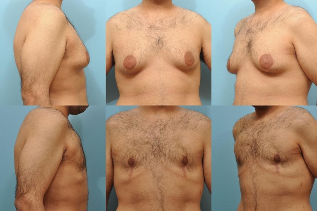 The Plastic Surgery Group gynecomastia result — Montclair, NJ