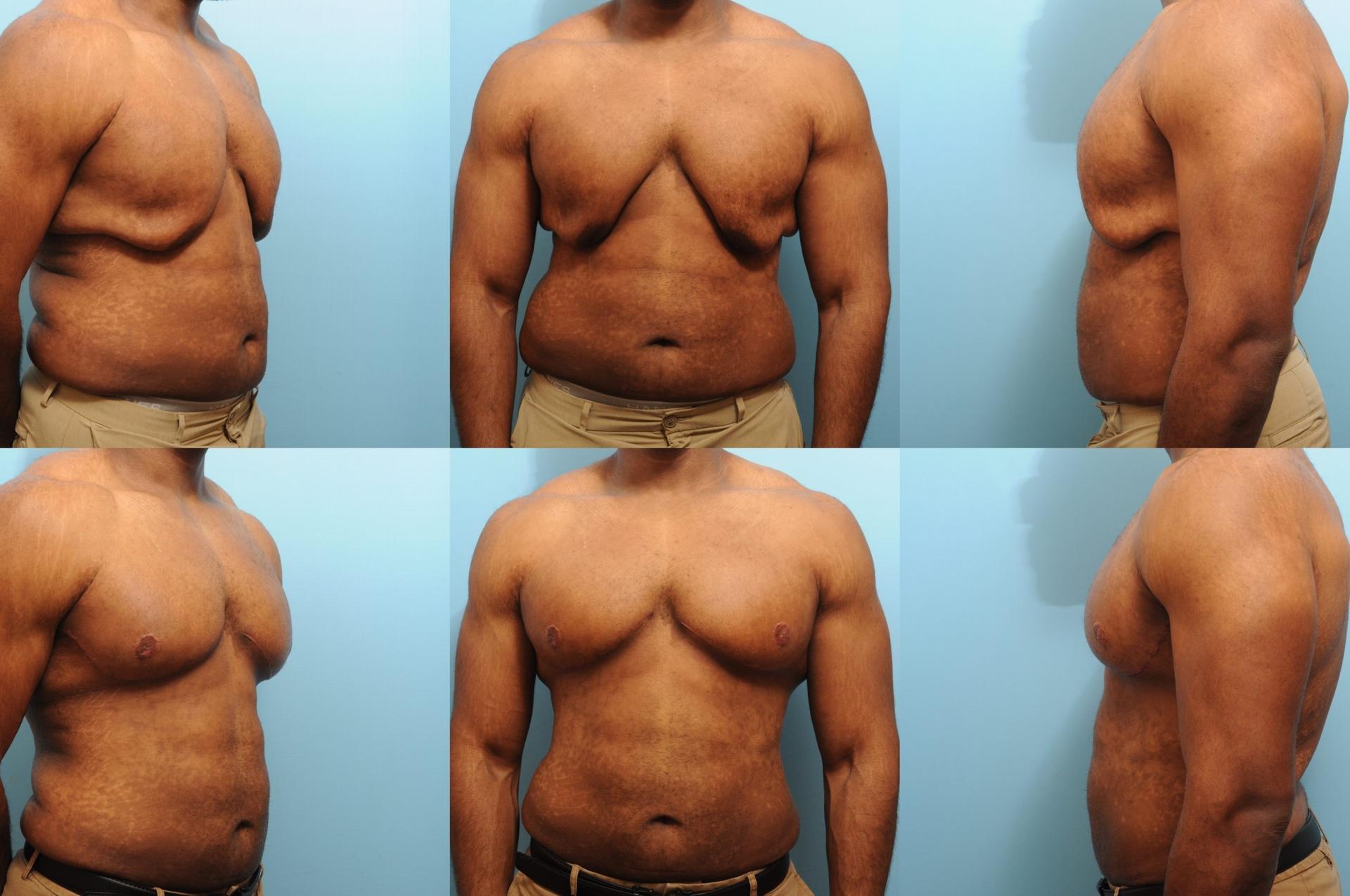 The Plastic Surgery Group gynecomastia result — Montclair, NJ