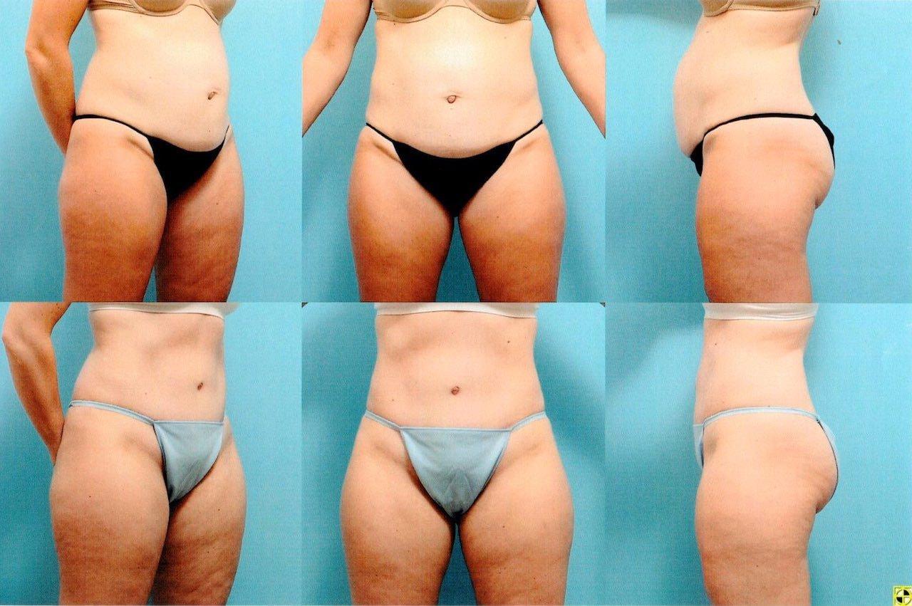 The Plastic Surgery Group tummy tuck result — Montclair, NJ