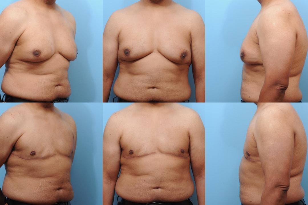 The Plastic Surgery Group gynecomastia result — Montclair, NJ