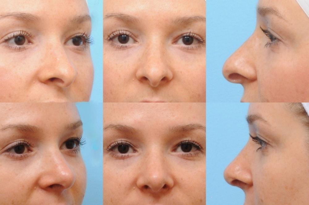 The Plastic Surgery Group rhinoplasty result — Montclair, NJ