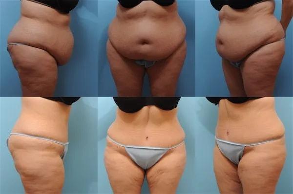 The Plastic Surgery Group tummy tuck result — Montclair, NJ