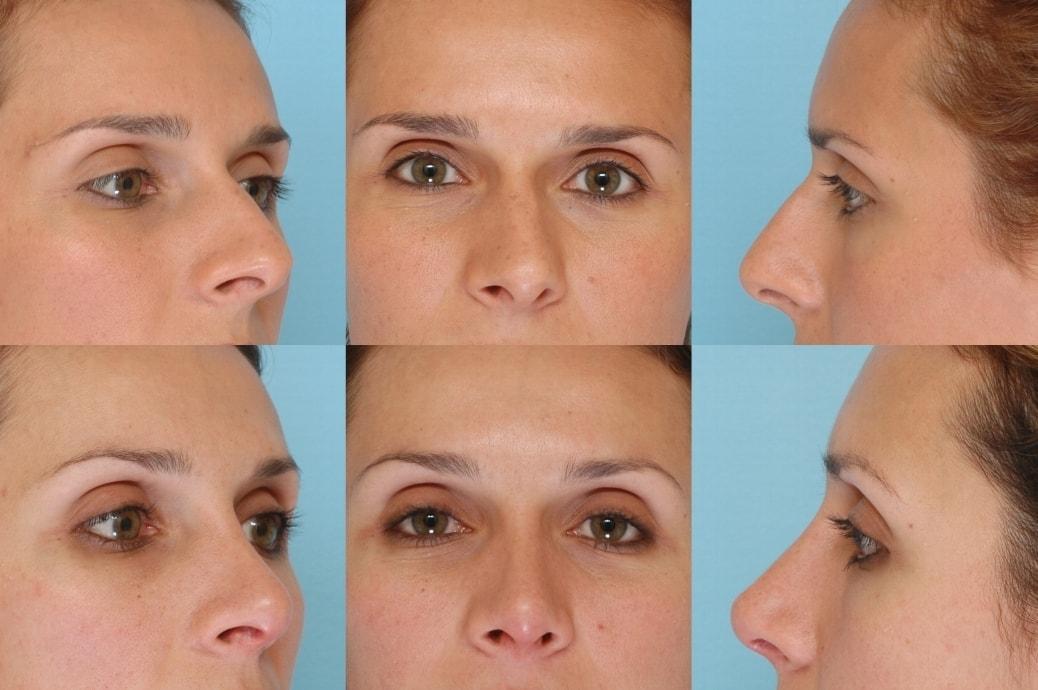 The Plastic Surgery Group rhinoplasty result — Montclair, NJ